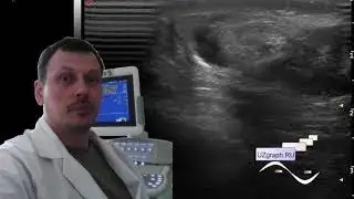 Pediatric Scrotal ultrasound - Hypoplasia of the testicle, torsion of the spermatic cord