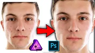 ¿Como QUITAR GRANOS de la piel? / CHOCHY
