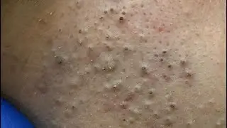 Advanced Blackhead Removal — Clear Complexion Solutions
