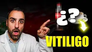 Vitíligo y Bebidas: ¿Qué TOMAR y qué EVITAR?