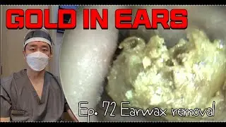 귓속에 금을 숨긴 남자 (Ep. 72) (Korean ENT doctor “King of earwax” Ep. 72 earwax removal)