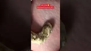 Black head removal on face - Blackheads on back treatment