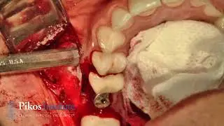 Pikos Institute - Sinus Graft with Implant Placement Using Osseodensification