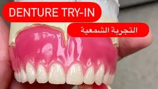 MAKING COMPLETE DENTURES IN WAX. صناعة الدينچر بالشمع (كل الخطوات) #waxbae #dentures