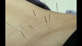 허리 삐긋했을때 한의원 가면? 요추염좌의 침치료 설명