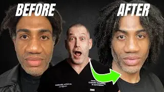 Unlocking a Sculpted Look: Male Facial Contouring BEFORE AND AFTER | Dr. Jason Emer