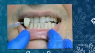 отбеливание зубов цены   - Как отбелить зубы