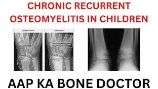 CHRONIC RECURRENT MULTIFOCAL OSTEOMYELITIS  IN CHILDREN - EPISODE 64