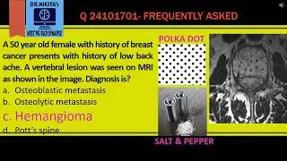 Polka dot sign- Vertebral hemangioma