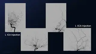 A Superficial Temporal Artery to Middle Cerebral Artery Bypass for Moyamoya Disease