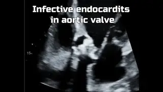 Infective Endocarditis AV