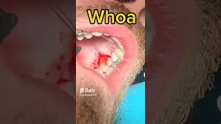 Do you do this before a FILLING?