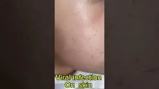 Viral infection on skin #skin care #health #short