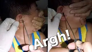 Removing Boy's Hard Earwax | Look! How Difficult It Is to Remove It