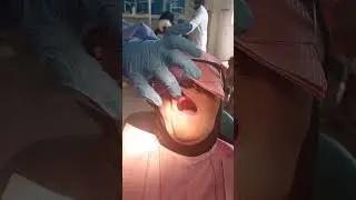 final impression for patient with flabby ridge by windows technique