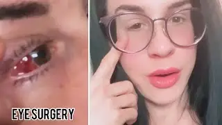 Strabismus Eye Surgery Complete 👁️