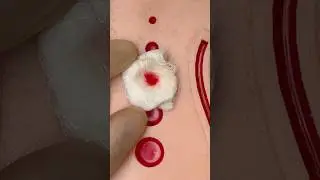 Gunshot Wound First Aid ⛑️ 
