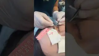 Верхняя блефаропластика