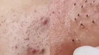 Best Oddly Satisfying Video Membersihkan Muka dari Jerawat yang Membandel