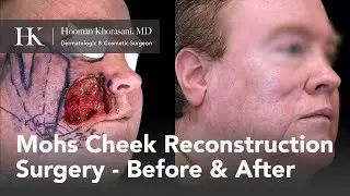 Mohs Micrographic Surgery & Reconstruction | Cheek Before & After Montage | Dr. Hooman Khorasani