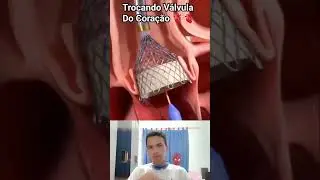 #shots #videoshort simulação de troca de válvula de coração 🫀🫀🫀