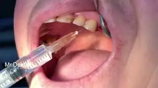 Extraction Of A Broken Tooth   !!!!!