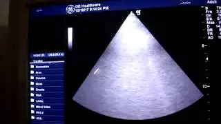 B LINES ON LUNG ULTRASOUND IN CARDIOGENIC PULMONARY EDEMA