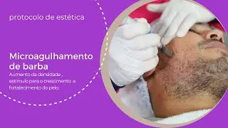 Protocolo de  Microagulhamento com Dermapen  para Barba