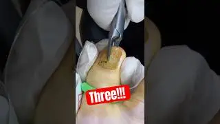 Fungus Toenail Treatment 😳