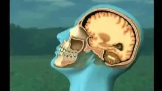 Medical Imaging - Brain Injury from Collision Impact