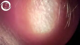 Ophthalmic Signs Eyelids