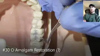 #30 O Amalgam Restoration 1