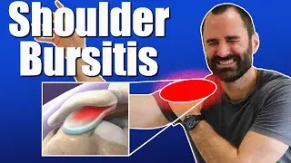Shoulder Bursitis: Symptoms, Causes, and Effective Exercises for Shoulder Pain