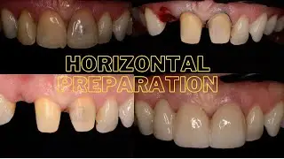 HORIZONTAL PREPARATION