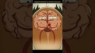 Treatment of cerebral aneurysm