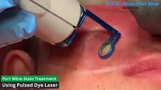 Fading the Red: Pulsed Dye Laser Treatment for Port Wine Stain #portwinestain #birthmarklaserremoval