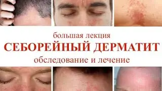 Новая большая лекция по СЕБОРЕЙНОМУ ДЕРМАТИТУ (60мин)