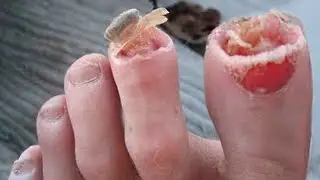 ISSO estava comendo meus dedos dos pés