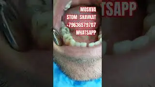 PLOMBA OSTIDA TISH CARIESI ! #moskva #migrantes #stomatologia