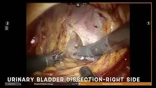 Robotic Total Pelvic Exenteration