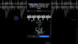 iQ3 New Features | Butterfly Network