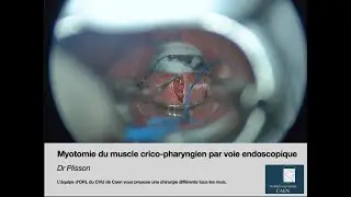 Myotomie du muscle crico-pharyngien par voie endoscopique