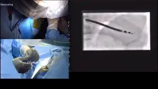 Biomedical Medtronic Clinical  Specialist Checking Heart Parameters Using Pacemaker Programmer