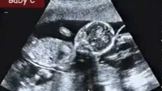 Wilkinson quintuplets ultrasound 3: indentifying gender