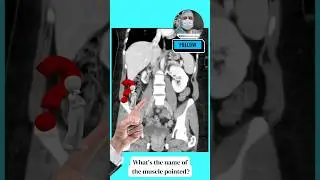 Name the muscle pointed in the CT abdomen & pelvis?  #youtubeshorts #trending #viral #neet #video