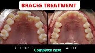 🤗🤗Braces monthly progress | Before and after Time-lapse | Orthodontic treatment | your dentist