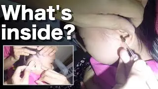 HUGE Earwax Removed from Girl's Ear But Wait There's More...