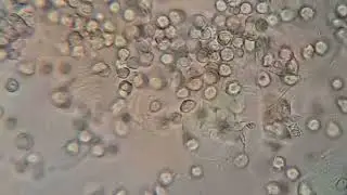 pus cells in urine sample under microscope 🔬 👌