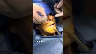 Dr. Minton's Lip Lift Technique