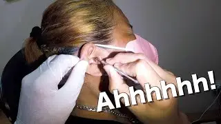 Sticky Earwax Stuck In Woman's Ear Canal Removed